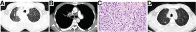 Small cell lung cancer transformation and tumor heterogeneity after sequential targeted therapy and immunotherapy in EGFR-mutant non-small cell lung cancer: A case report
